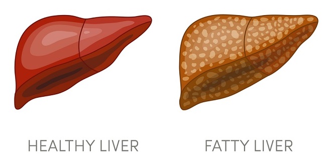fasting can cure fatty liver disease