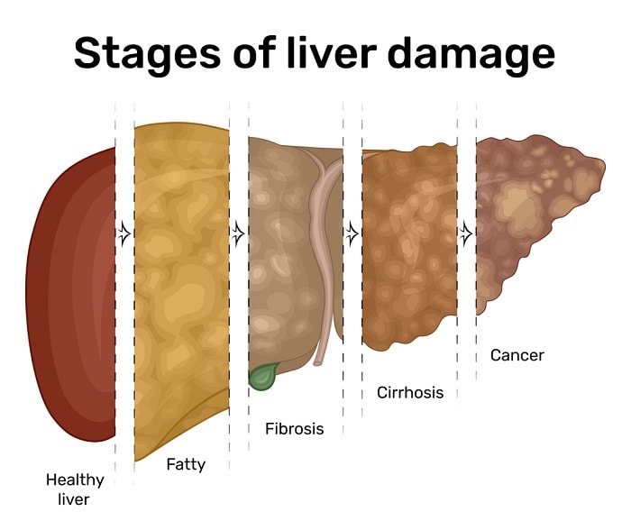 fasting-to-cure-fatty-liver-why-it-works-how-to-start